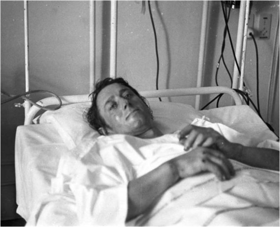 René Desmaison in hospital after spending 342 hours on the face during his first attempt
